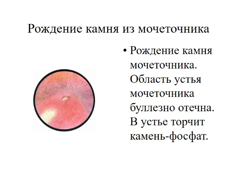 Рождение камня мочеточника. Область устья мочеточника буллезно отечна. В устье торчит камень-фосфат.  Рождение